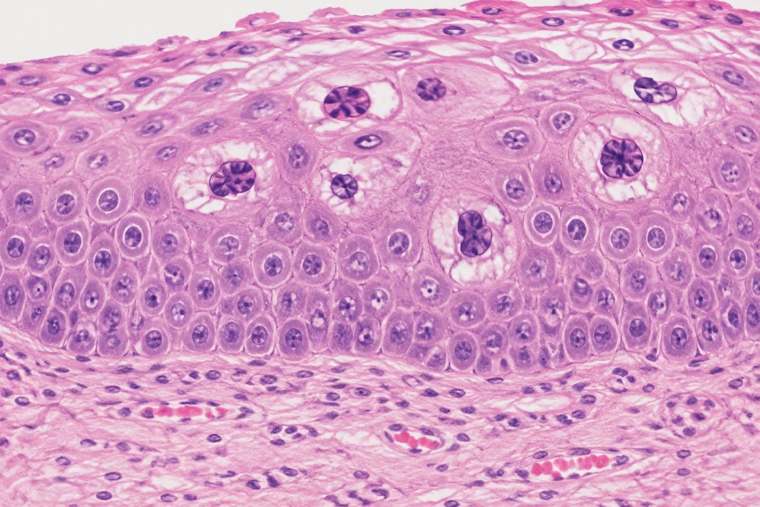 découvrez les caractéristiques des koilocytes, leur lien avec le papillomavirus humain (hpv) et leur signification dans l’interprétation médicale.